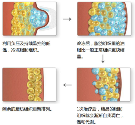 和闺蜜一起回归学生时代身材！青岛伊美尔引进第二套酷塑减脂系统