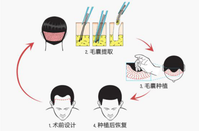 如何选择植发医院？杭州新生植发医院专家权威解读！