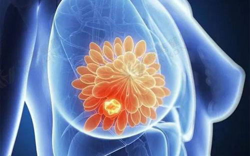 乳腺癌新药Kadcyla显著改善患者生存期