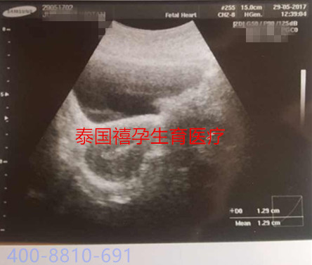 禧孕泰国试管婴儿Jetanin冷冻卵子是否靠谱？