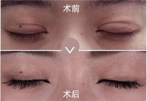 爱德丽格刘志刚小讲堂（六）：双眼皮闭眼有疤，怎么破？