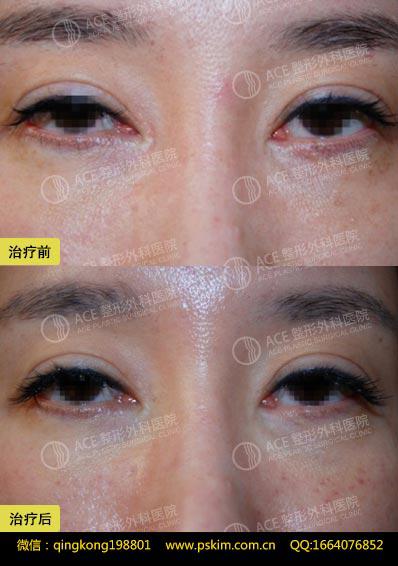 开眼角术后增生？韩国ACE修复医院给你完美的解决办法！
