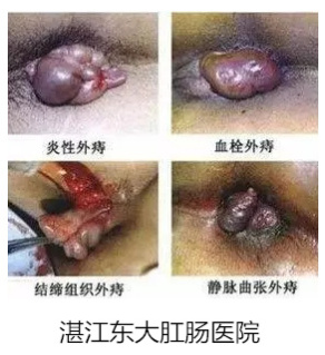 外痔2.副本.jpg