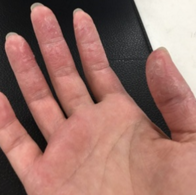 手癣怎么治才能去根？这些事项一定要注意
