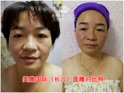 什么是手绣美雕和一根针微整形 市场主任柳瑞珍