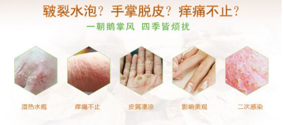 水疱鳞屑手癣真可怕  这种治疗方法您知道吗？